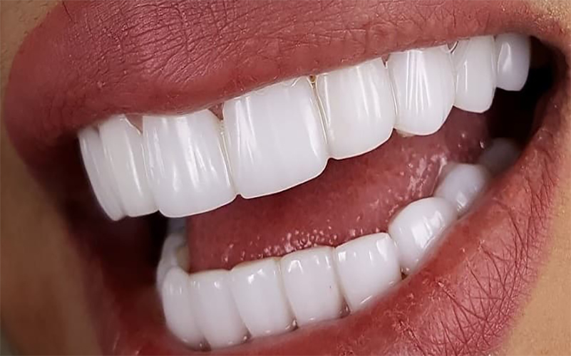 کامپوزیت دندان